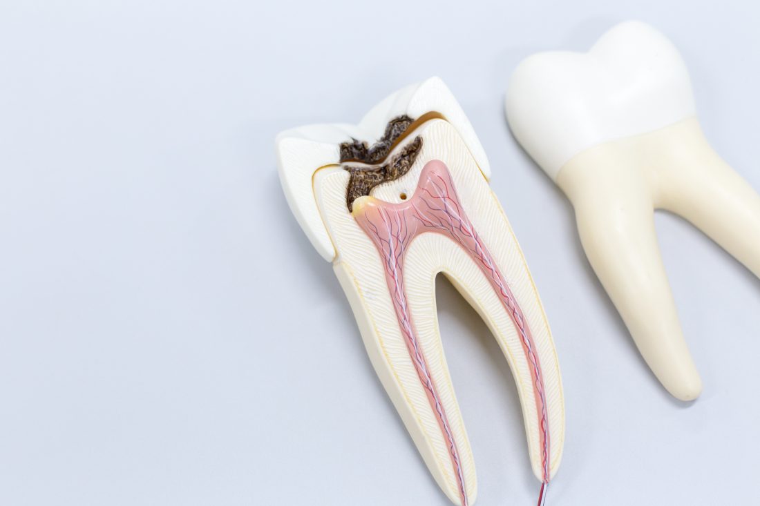 虫歯の歯のイメージ