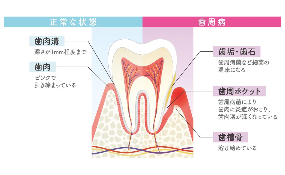 正常な状態と歯周病のイメージ