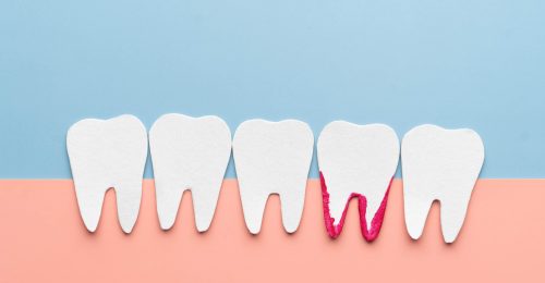歯周病の歯イメージ